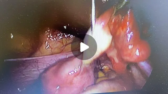 Yumurtalıklara yönelik kök hücre uygulamaları